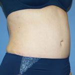 Tummy Tuck Before & After Patient #5621