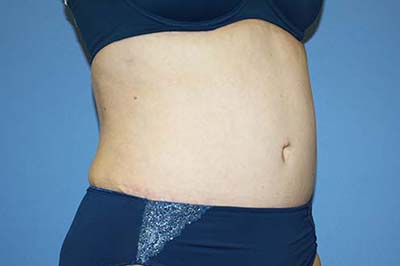 Tummy Tuck Before & After Patient #5621