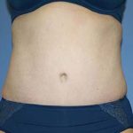 Tummy Tuck Before & After Patient #5621