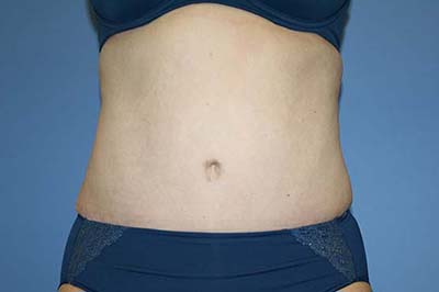 Tummy Tuck Before & After Patient #5621