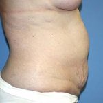 Tummy Tuck Before & After Patient #5621