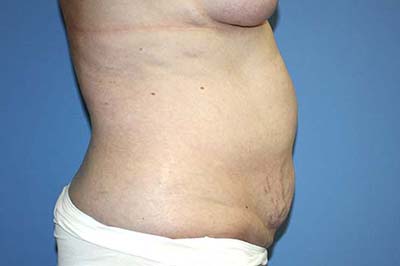 Tummy Tuck Before & After Patient #5621