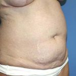 Tummy Tuck Before & After Patient #5621