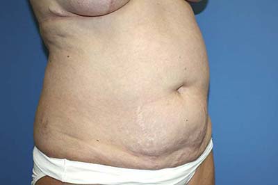 Tummy Tuck Before & After Patient #5621