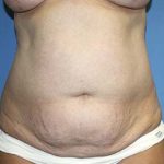 Tummy Tuck Before & After Patient #5621