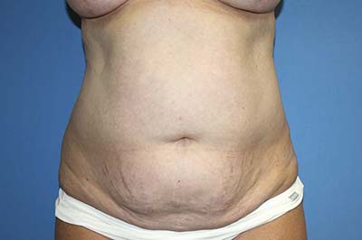 Tummy Tuck Before & After Patient #5621