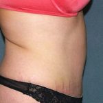 Tummy Tuck Before & After Patient #5624