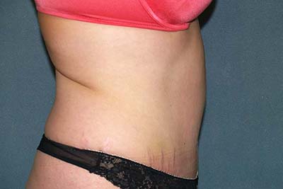 Tummy Tuck Before & After Patient #5624