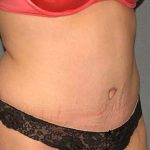 Tummy Tuck Before & After Patient #5624