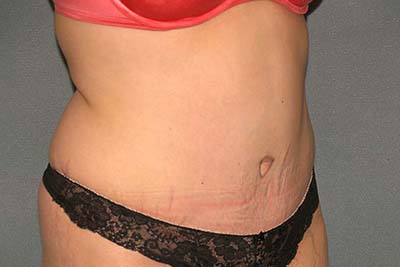 Tummy Tuck Before & After Patient #5624