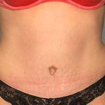 Tummy Tuck Before & After Patient #5624