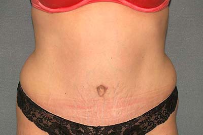 Tummy Tuck Before & After Patient #5624