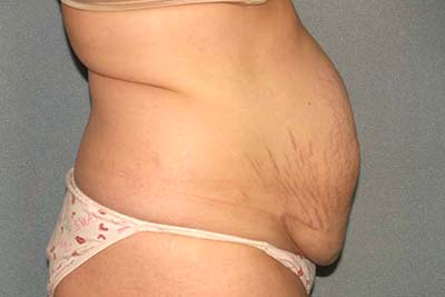 Tummy Tuck Before & After Patient #5624