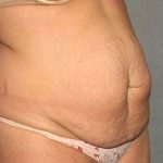 Tummy Tuck Before & After Patient #5624