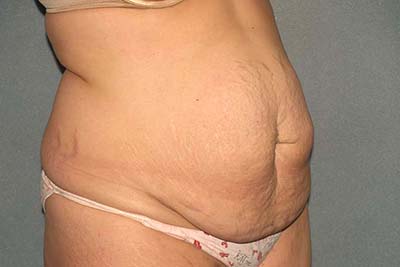 Tummy Tuck Before & After Patient #5624