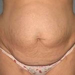 Tummy Tuck Before & After Patient #5624