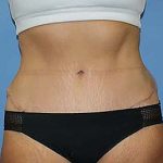 Tummy Tuck Before & After Patient #7242