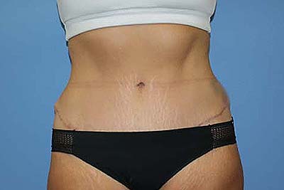 Tummy Tuck Before & After Patient #7242