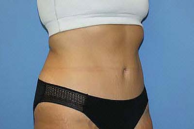 Tummy Tuck Before & After Patient #7242