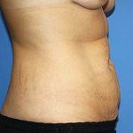 Tummy Tuck Before & After Patient #7242