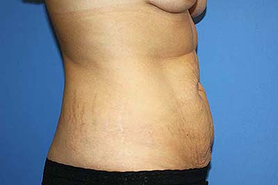 Tummy Tuck Before & After Patient #7242