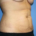 Tummy Tuck Before & After Patient #7242