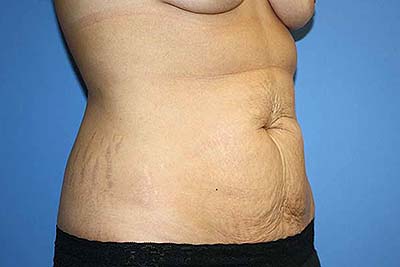 Tummy Tuck Before & After Patient #7242