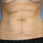 Tummy Tuck Before & After Patient #7242