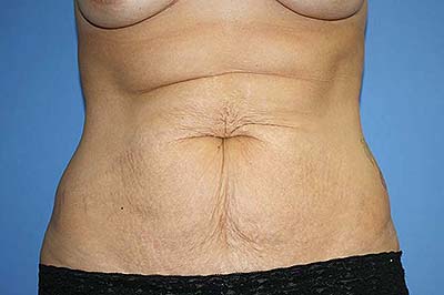 Tummy Tuck Before & After Patient #7242