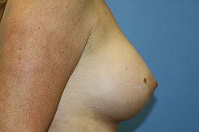 Breast Augmentation Before & After Patient #7090