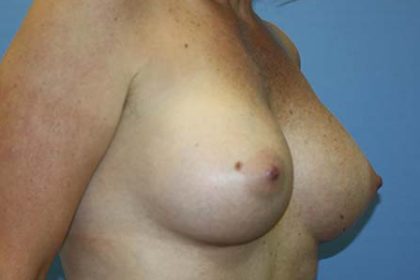 Breast Augmentation Before & After Patient #7090