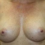 Breast Augmentation Before & After Patient #7090