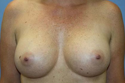 Breast Augmentation Before & After Patient #7090