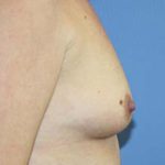 Breast Augmentation Before & After Patient #7090