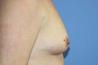 Breast Augmentation Before & After Patient #7090