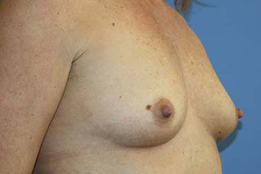 Breast Augmentation Before & After Patient #7090