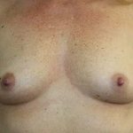 Breast Augmentation Before & After Patient #7090