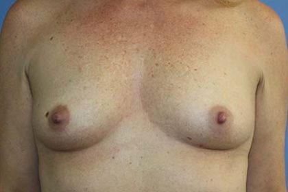 Breast Augmentation Before & After Patient #7090