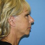 Facelift Before & After Patient #7297