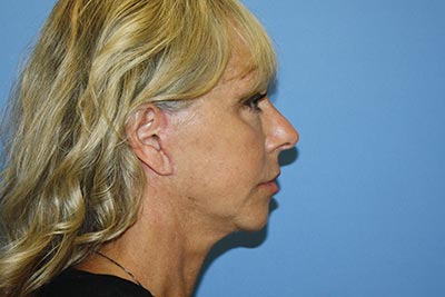 Facelift Before & After Patient #7297