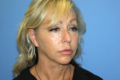 Facelift Before & After Patient #7297