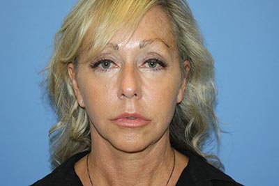 Facelift Before & After Patient #7297