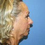 Facelift Before & After Patient #7297