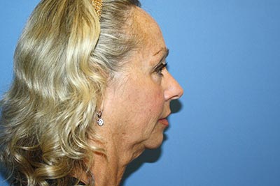 Facelift Before & After Patient #7297