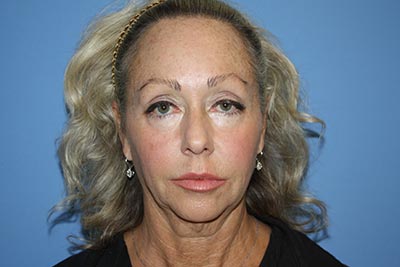 Facelift Before & After Patient #7297