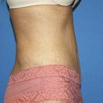 Tummy Tuck Before & After Patient #5664