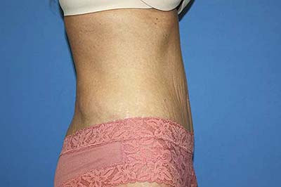 Tummy Tuck Before & After Patient #5664