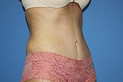 Tummy Tuck Before & After Patient #5664