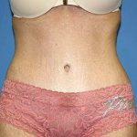 Tummy Tuck Before & After Patient #5664