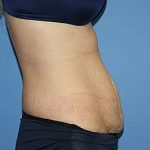 Tummy Tuck Before & After Patient #5664